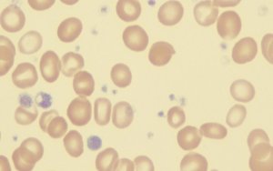 Acceleron and Celgene Blood Disease Drug Luspatercept Hits The Mark in Phase III Trial，美国新基公布贫血药物 luspatercept 三期试验取得积极数据