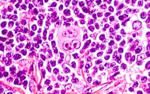 BeiGene Shows Off Strong Results from Checkpoint Inhibitor While Eying Potential Approval for BTK Inhibitor，百济神州公布PD-1抗体Tislelizumab治疗霍奇金淋巴瘤的关键性试验的初步主要结果